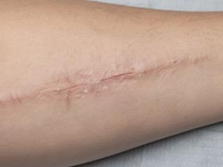 Healed scar camouflage reference