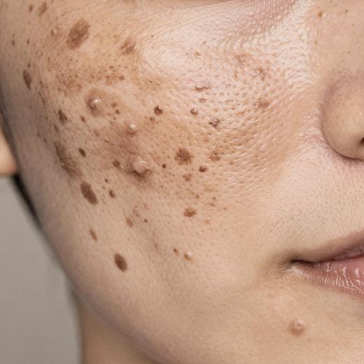 Healed beauty marks example