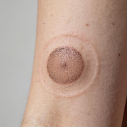 Healed scar coverage example